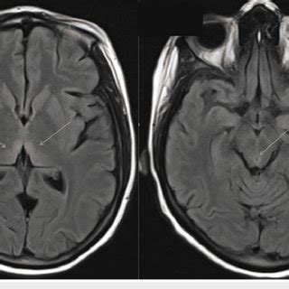 the villages brain mri with contrast|MRI with and without Contrast in the The Villages Region.